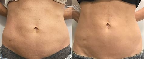 velashape 3 before and after